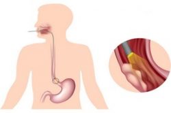 болезнь органов пищеварительной системы