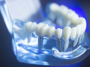 Срок службы и материалы, используемые для зубных имплантатов