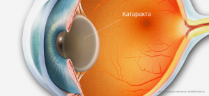 Лечение катаракты: восстановление четкого зрения для светлого будущего