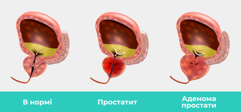Чому вам потрібно звернутися до клініки «Urologist Valetskyi», якщо є необхідність лікування аденоми простати